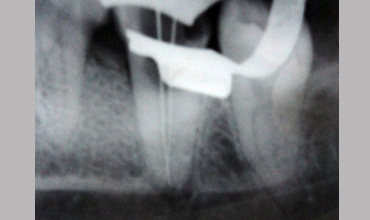 Dentures treatment in Anand
                        